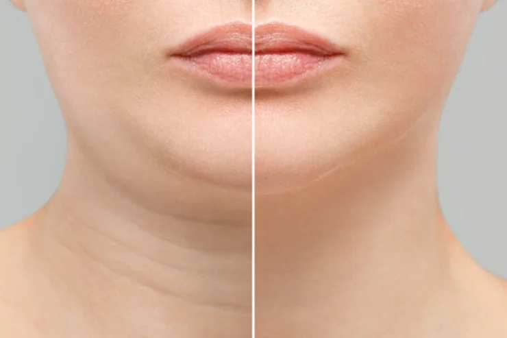 Double chin reduction