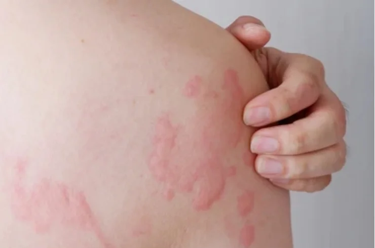 Urticaria control treatment-------13