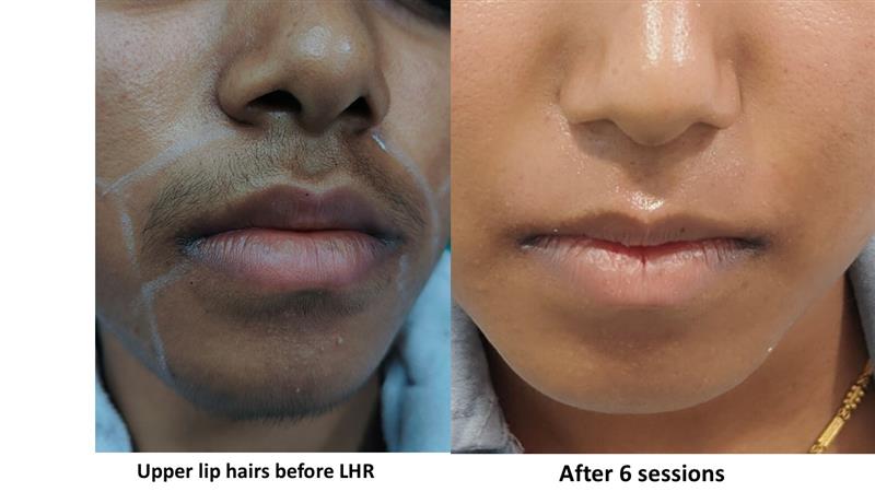 Laser Hair Reduction